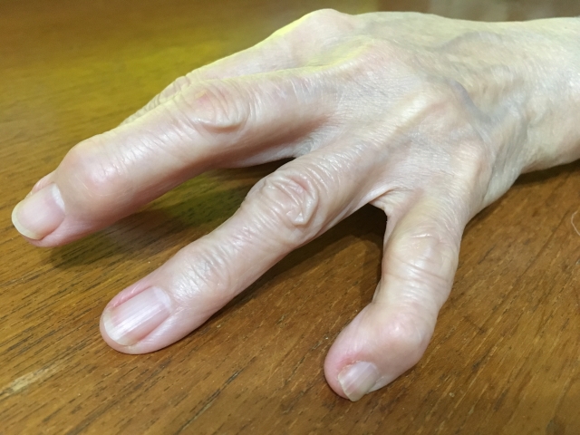 指 曲げる と 痛い 第 三 関節